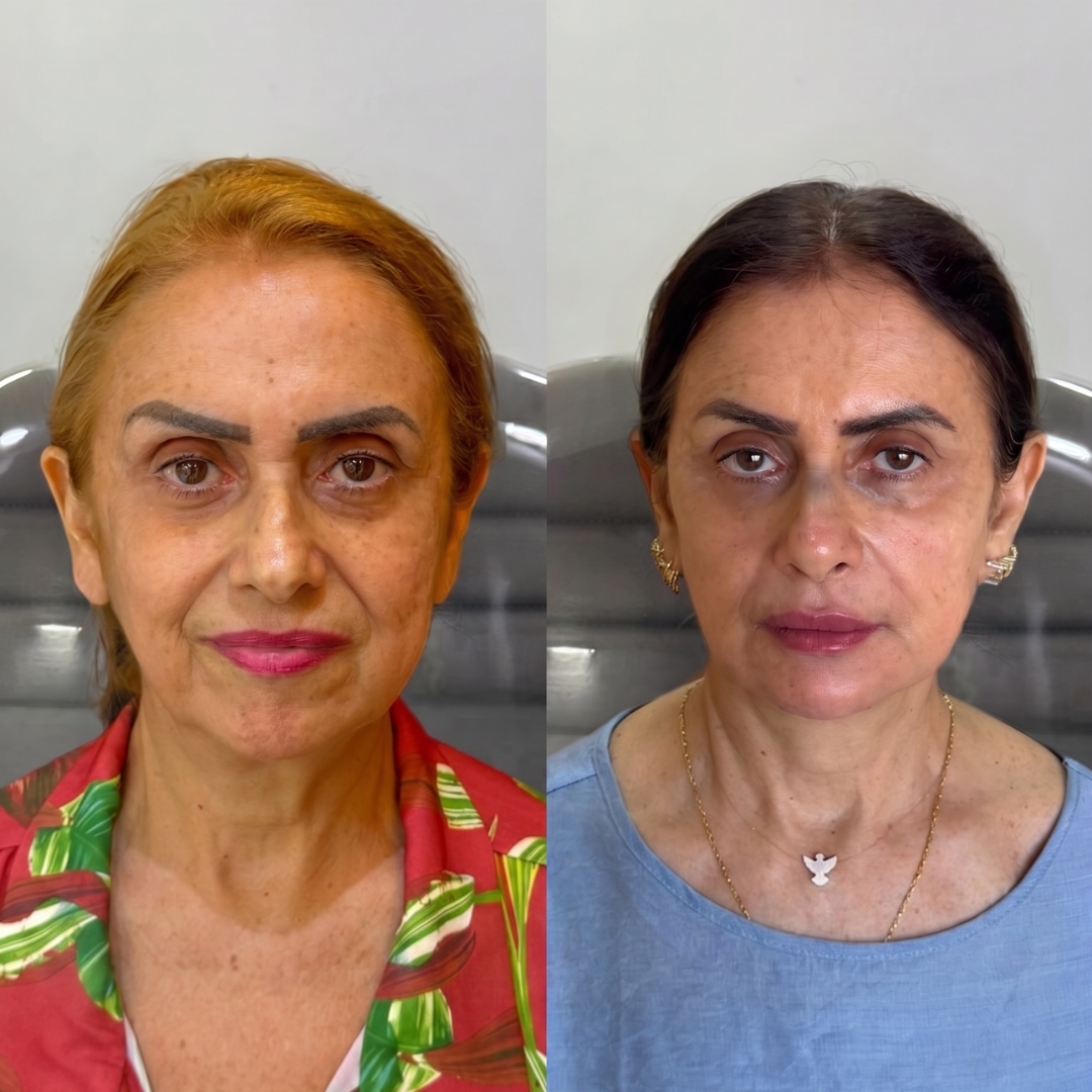 Galeria de resultados — antes e depois