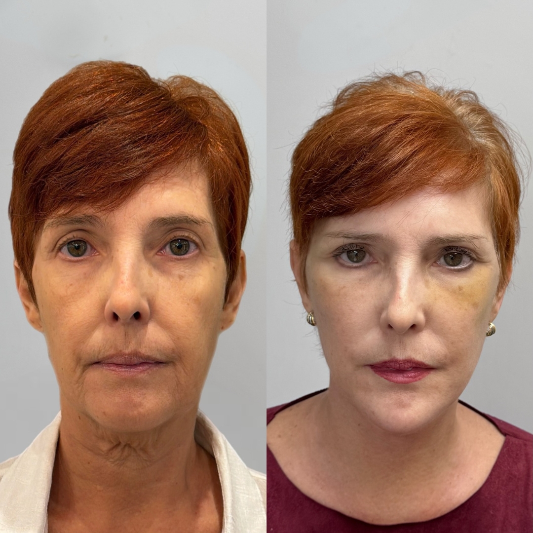 Galeria de resultados — antes e depois