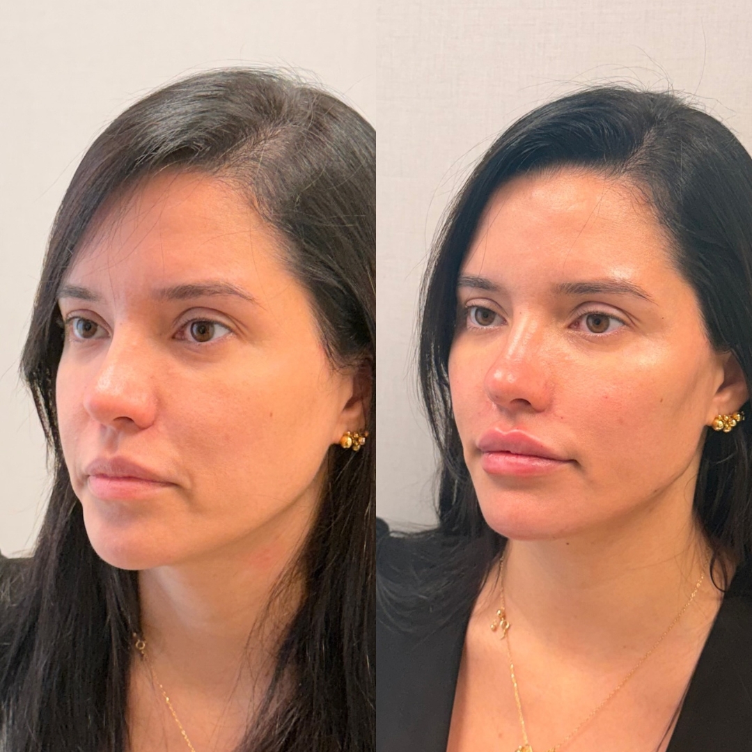 Galeria de resultados — antes e depois