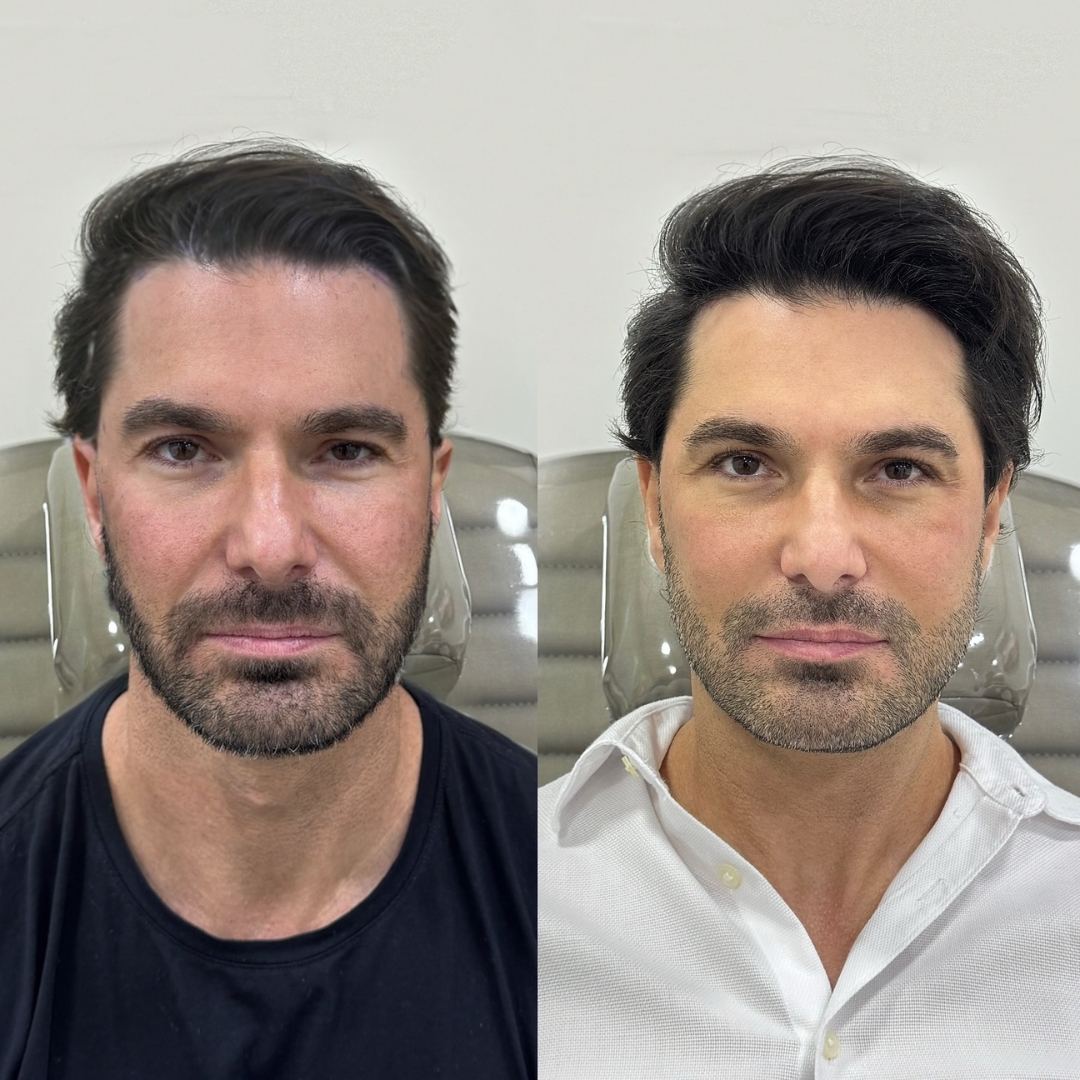 Galeria de resultados — antes e depois